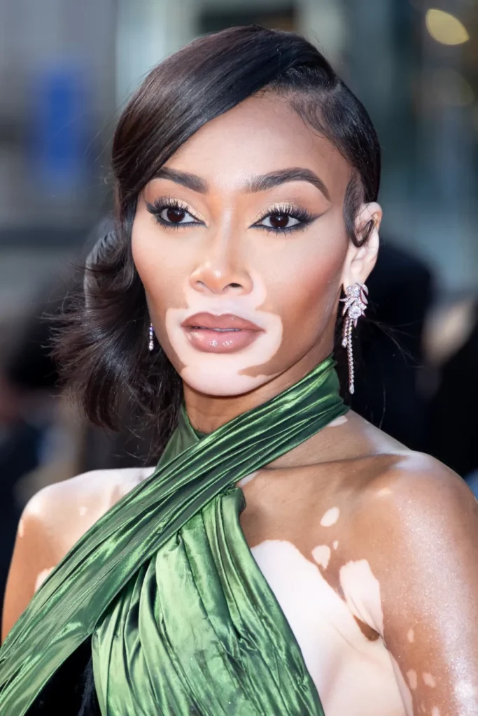 Chantelle Whitney Brown-Young, known professionally as Winnie Harlow, is a Canadian fashion model and public spokesperson on the skin condition vitiligo. She gained prominence in 2014 as a contestant on the 21st cycle of the U.S. television series America's Next Top Model.